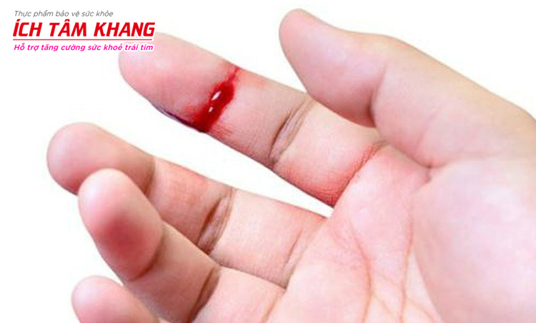 Thuốc Duoplavin có thể làm vết đứt tay khó cầm máu hơn bình thường
